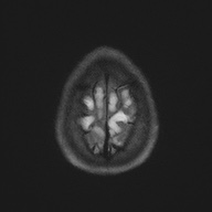Cerebral cavernous venous malformation (Radiopaedia 70008-80021 Axial DWI 59).jpg