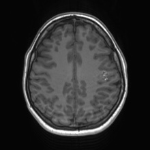 Cerebral cavernous venous malformation (Radiopaedia 70008-80021 Axial T1 56).jpg