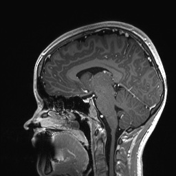 File:Cerebral cavernous venous malformation (Radiopaedia 70008-80021 Sagittal T1 C+ 33).jpg