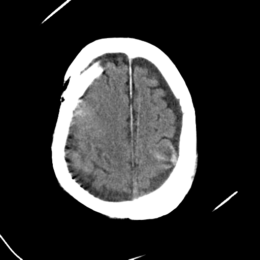 File:Cerebral contusions, subarachnoid hemorrhage and subdural hygromas (Radiopaedia 55399-61830 Axial non-contrast 24).png
