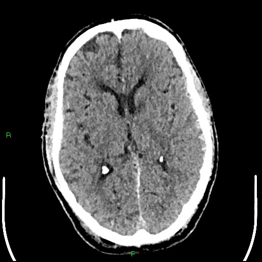 Cerebral contusions (Radiopaedia 33868-35039 Axial non-contrast 108).jpg