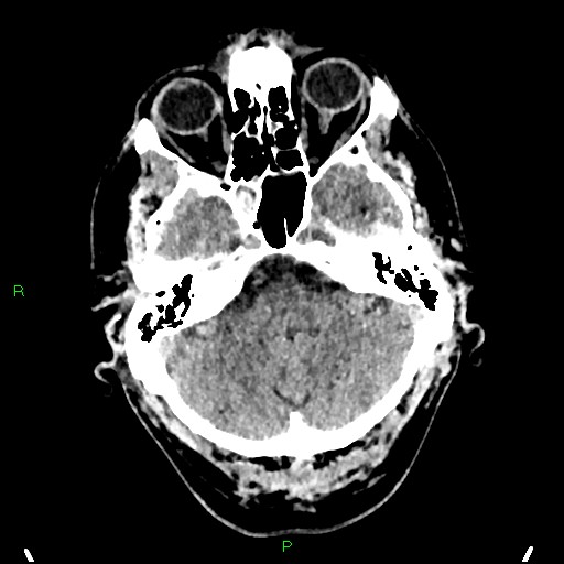 Cerebral contusions (Radiopaedia 33868-35039 Axial non-contrast 43).jpg
