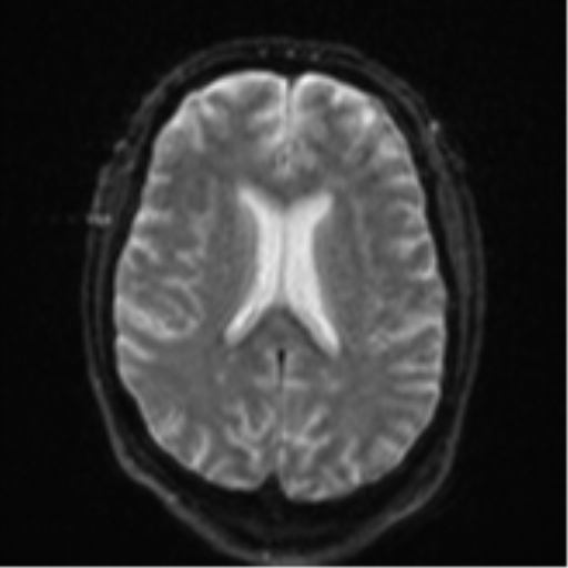 Cerebral embolic infarcts (embolic shower) (Radiopaedia 57395-64342 Axial DWI 22).png
