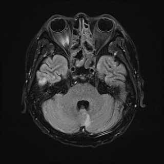 File:Cerebral embolic infarcts (embolic shower) (Radiopaedia 72391-82921 Axial FLAIR 9).jpg