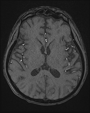 Cerebral embolic infarcts (embolic shower) (Radiopaedia 72391-82921 Axial MRA 102).jpg