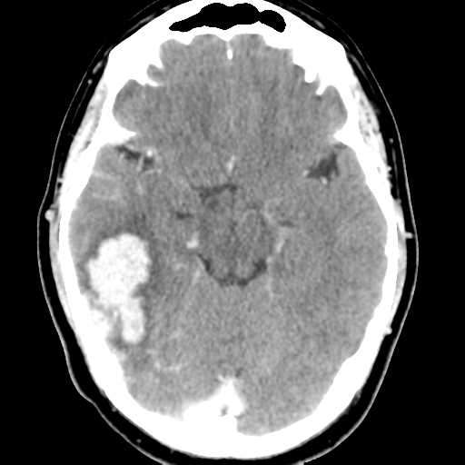 File:Cerebral hemorrhage secondary to arteriovenous malformation (Radiopaedia 33497-34561 B 22).png