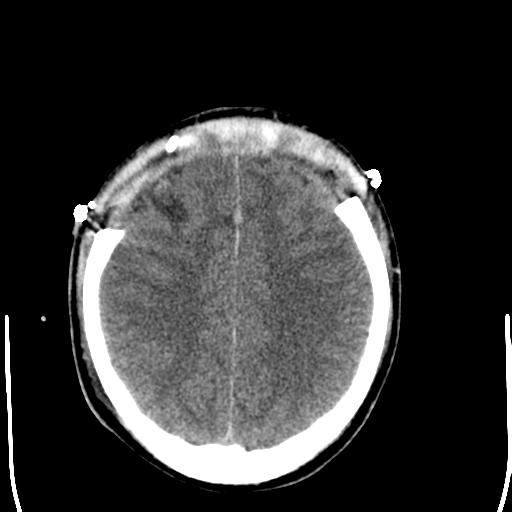 File:Cerebral hemorrhagic contusions- temporal evolution (Radiopaedia 40224-42755 AXIAL THICK 23).png