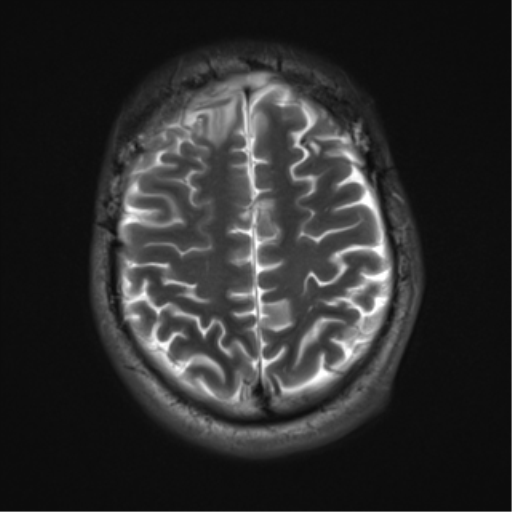 File:Cerebral hemorrhagic contusions- temporal evolution (Radiopaedia 40224-42757 Axial T2 18).png