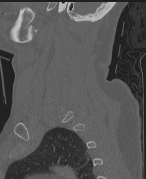 Cerebral hemorrhagic contusions and cervical spine fractures (Radiopaedia 32865-33841 Sagittal bone window 22).jpg