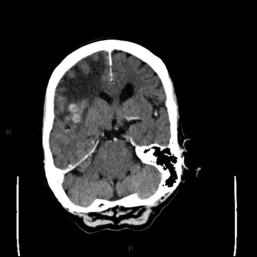 Cerebral metastases - breast primary (Radiopaedia 77653-89857 Axial C+ delayed 42).jpg
