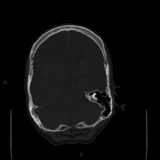 Cerebral metastases - breast primary (Radiopaedia 77653-89857 Axial bone window 42).jpg