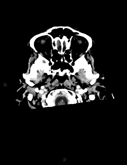Cerebral metastases - ependymal and parenchymal (Radiopaedia 79877-93131 Axial C+ delayed 5).jpg