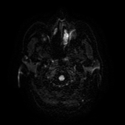 Cerebral metastases - melanoma (Radiopaedia 80972-94522 Axial DWI 3).jpg