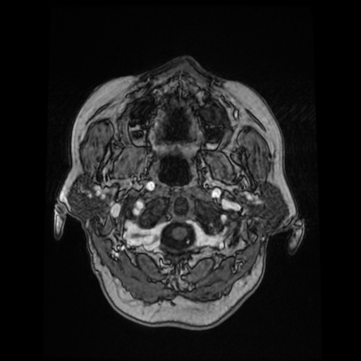 Cerebral metastases - melanoma (Radiopaedia 80972-94522 Axial T1 C+ 19).jpg