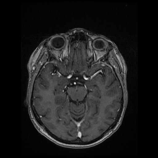 Cerebral metastases - melanoma (Radiopaedia 80972-94522 Axial T1 C+ 47).jpg