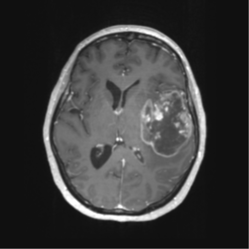 File:Cerebral metastasis mimicking glioblastoma (Radiopaedia 69155-78937 Axial T1 C+ 35).png