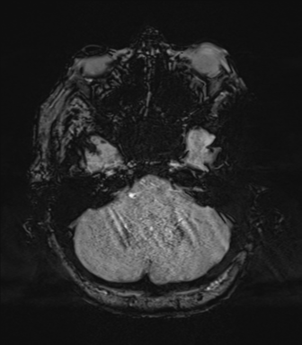 File:Cerebral metastasis to basal ganglia (Radiopaedia 81568-95413 Axial SWI 16).png