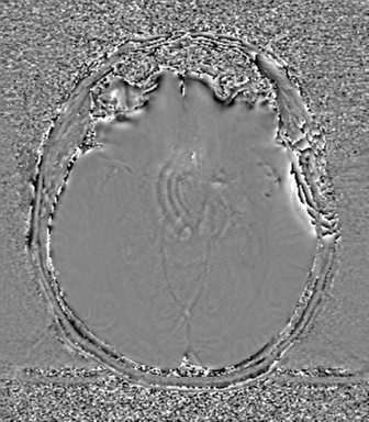 Cerebral metastasis to basal ganglia (Radiopaedia 81568-95413 Axial SWI phase 35).png