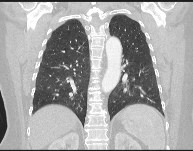 Cerebral metastasis to basal ganglia (Radiopaedia 81568-95414 Coronal lung window 59).png