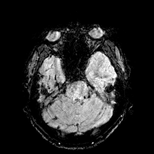 Cerebral parenchymal arteriovenous malformation (Radiopaedia 27280-27456 Axial SWI 26).jpg