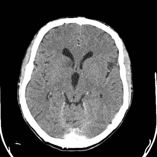 File:Cerebral toxoplasmosis (Radiopaedia 43956-47460 Axial C+ delayed 15).jpg