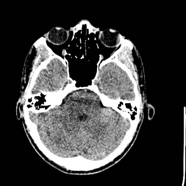 Cerebral toxoplasmosis (Radiopaedia 53993-60131 Axial non-contrast 24).jpg
