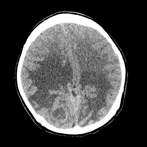 Cerebral tuberculosis with dural sinus invasion (Radiopaedia 60353-68018 Axial non-contrast 37).jpg