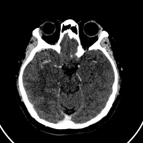 Cerebral venous hemorrhagic infarct from venous sinus thrombosis (Radiopaedia 55433-61883 Axial C+ delayed 94).jpg