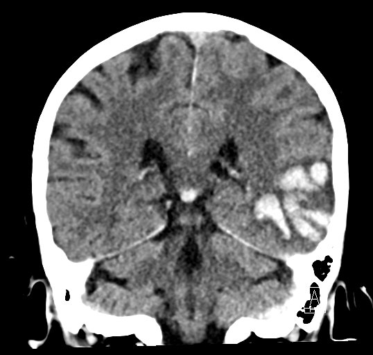 Cerebral venous infarction with hemorrhage (Radiopaedia 65343-74381 Coronal non-contrast 35).jpg