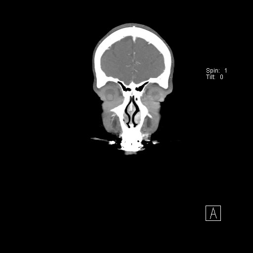 Cerebral venous infarction with hemorrhage (Radiopaedia 65343-74396 B 26).jpg