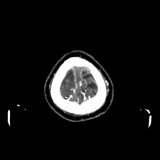 File:Cerebral venous throbmosis - hemorrhagic venous infarction (Radiopaedia 87318-103613 Axial CT venogram 39).jpg