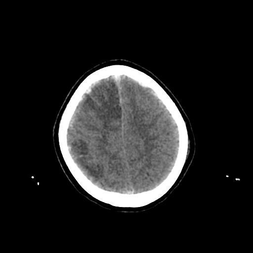 File:Cerebral venous throbmosis - hemorrhagic venous infarction (Radiopaedia 87318-103613 Axial non-contrast 141).jpg
