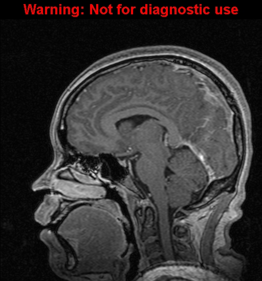 Cerebral venous thrombosis (Radiopaedia 37224-39208 Sagittal T1 C+ 81).jpg