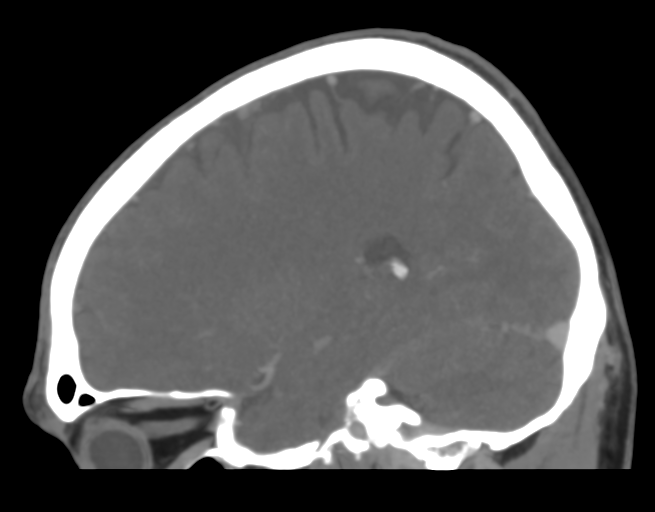 Cerebral venous thrombosis (Radiopaedia 38392-40467 D 18).png