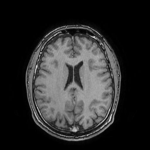 Cerebral venous thrombosis with secondary intracranial hypertension (Radiopaedia 89842-106957 Axial T1 C+ 113).jpg