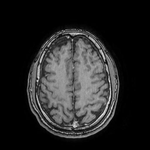 File:Cerebral venous thrombosis with secondary intracranial hypertension (Radiopaedia 89842-106957 Axial T1 C+ 130).jpg