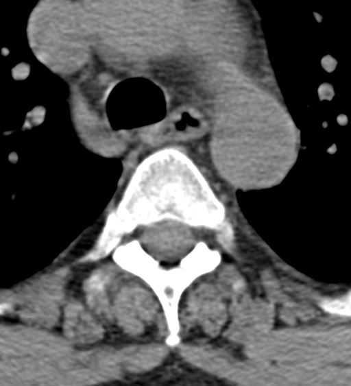 Cervical canal stenosis - OPLL and osteophytes (Radiopaedia 47329-51910 Axial non-contrast 79).png