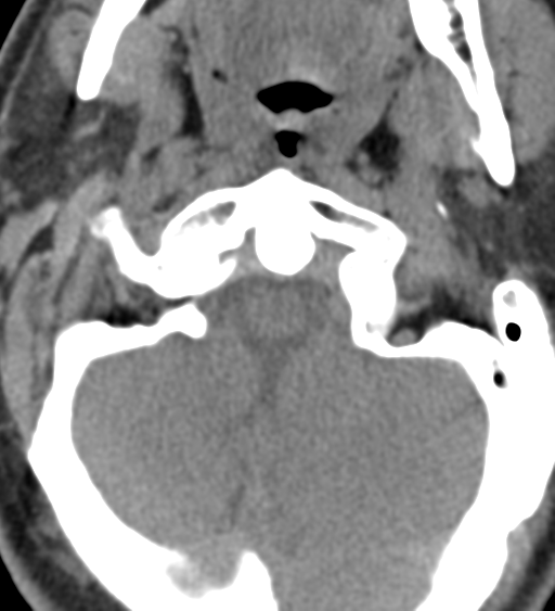 File:Cervical canal stenosis due to ossification of the posterior longitudinal ligament (Radiopaedia 47260-51823 Axial non-contrast 11).png
