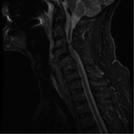 File:Cervical canal stenosis with cord compression (Radiopaedia 34114-35374 Sagittal STIR 7).png