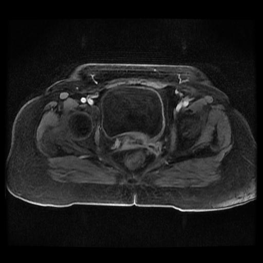 Cervical carcinoma (Radiopaedia 70924-81132 Axial T1 C+ fat sat 220).jpg