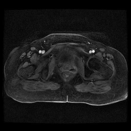 Cervical carcinoma (Radiopaedia 70924-81132 Axial T1 C+ fat sat 33).jpg