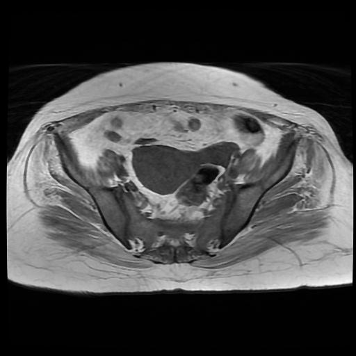 File:Cervical carcinoma (Radiopaedia 88010-104555 Axial T1 7).jpg