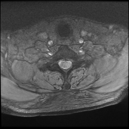 Cervical disc extrusion (Radiopaedia 59074-66364 F 49).jpg