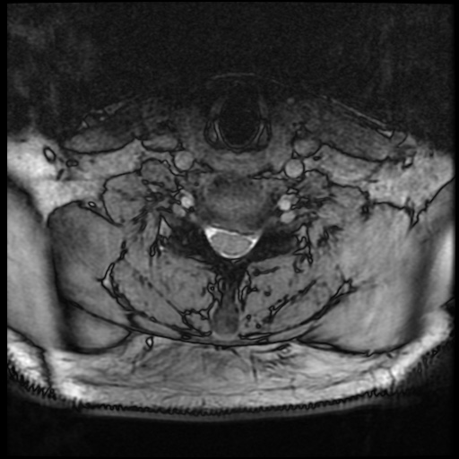 Cervical disc extrusion (Radiopaedia 59074-66364 G 72).jpg
