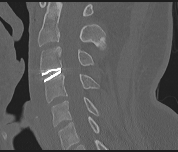 Cervical disc replacement (Radiopaedia 44025-47541 Sagittal bone window 45).png