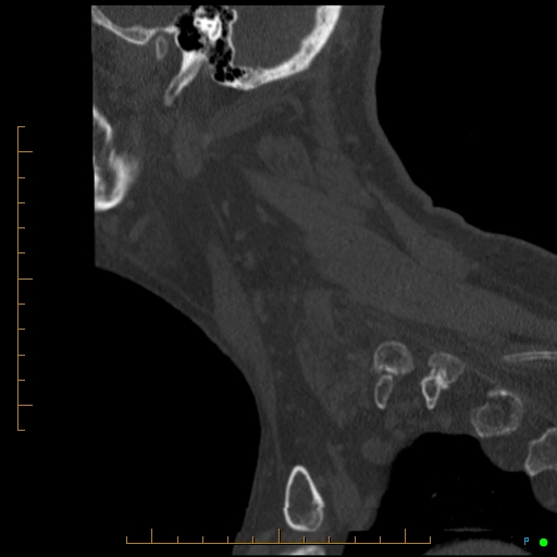 Cervical spine fracture - ankylosing spondylitis (Radiopaedia 76835-88706 Sagittal bone window 19).jpg
