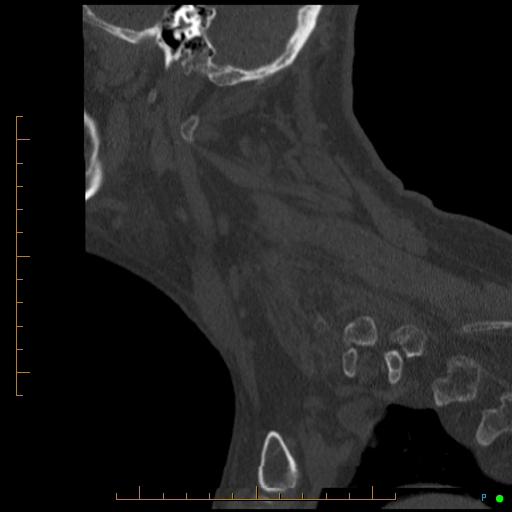 Cervical spine fracture - ankylosing spondylitis (Radiopaedia 76835-88706 Sagittal bone window 22).jpg