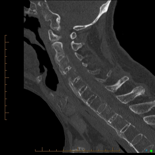 Cervical spine fracture - ankylosing spondylitis (Radiopaedia 76835-88706 Sagittal bone window 51).jpg