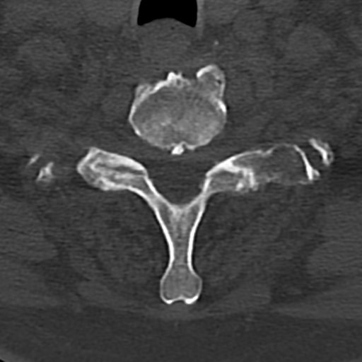 Cervical spine fracture - chalk stick (Radiopaedia 39116-41323 Axial bone window 76).png