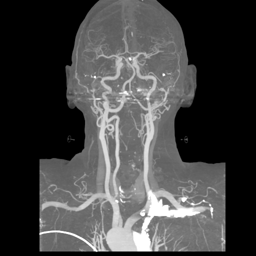 File:Cervical spine fractures with vertebral artery dissection (Radiopaedia 53296-59269 3D MIP 10).png